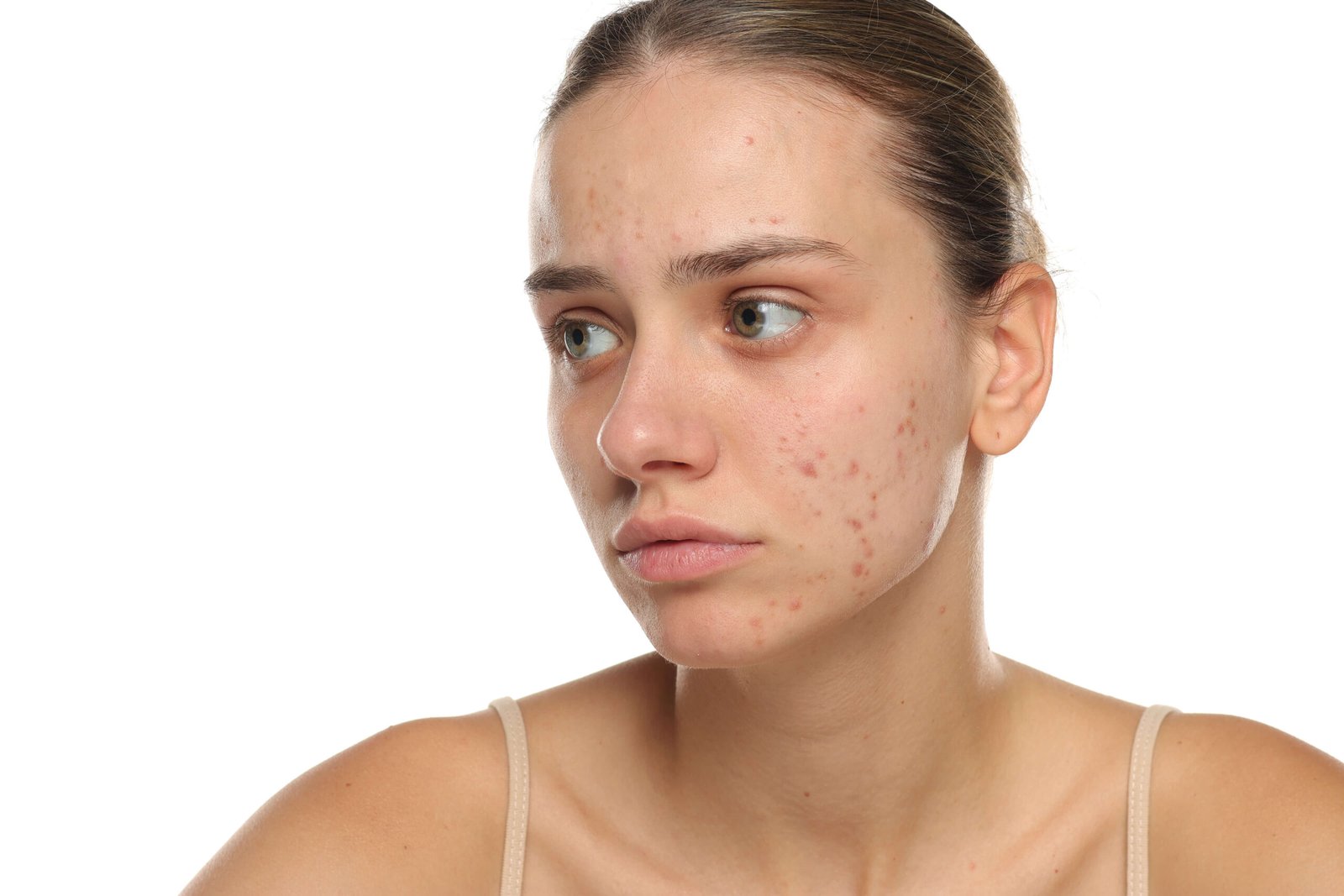 Adult woman with persistent inflammatory acne breakouts on cheek and jawline