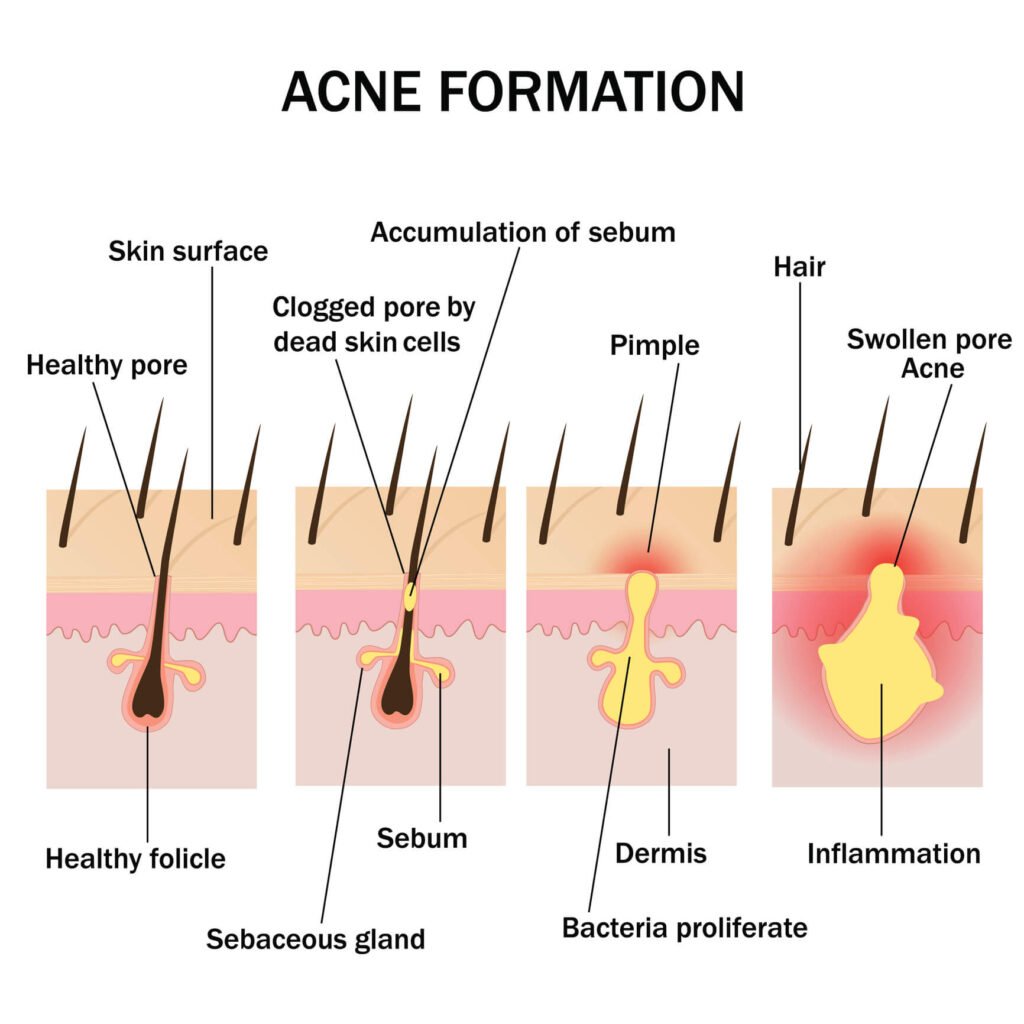 Medical diagram showing four stages of acne formation: healthy pore, sebum accumulation, bacterial proliferation, and inflammation