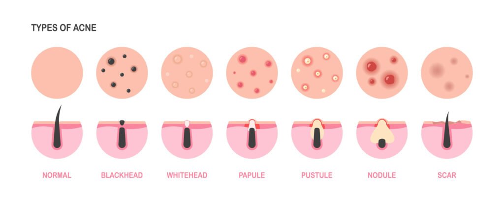 Visual guide to seven types of acne: normal skin, blackhead, whitehead, papule, pustule, nodule, and acne scar