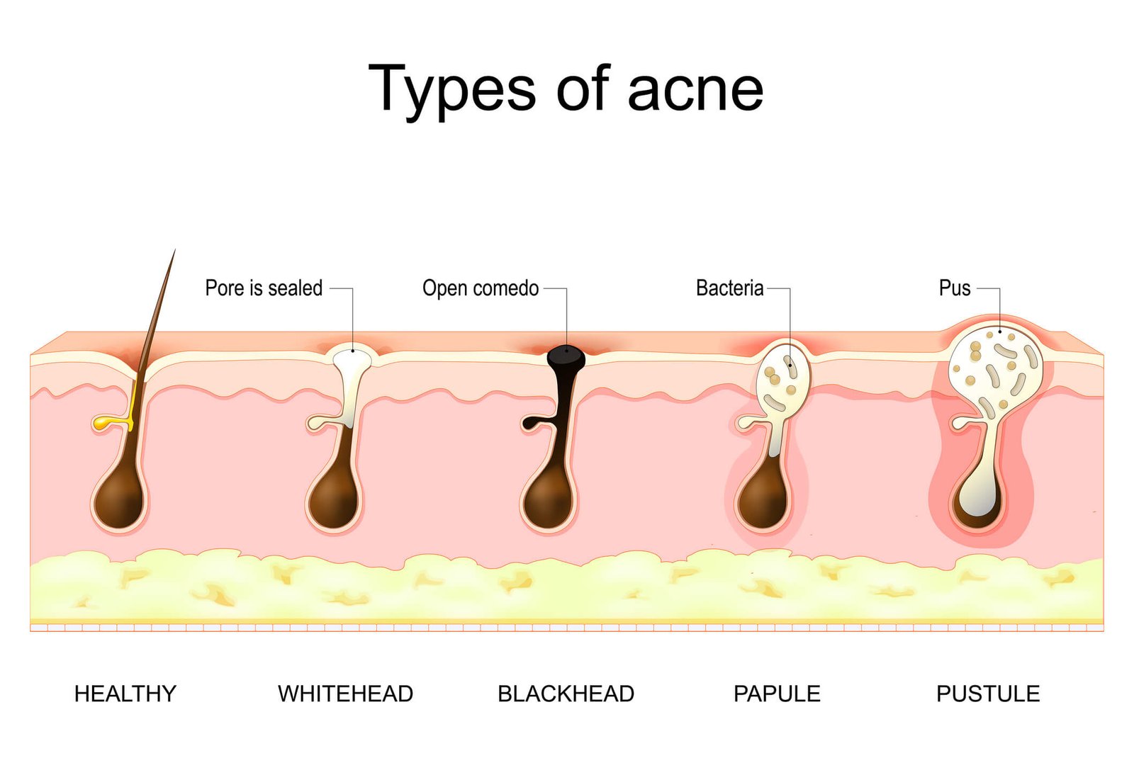 Types of acne — blackhead, whitehead, papule, pustule, nodule and cyst illustrated