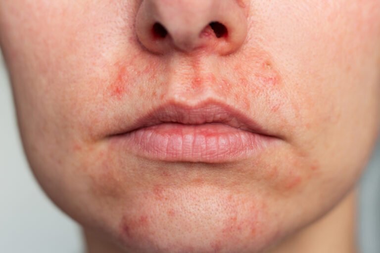 Perioral dermatitis — small red papules around the mouth and nasolabial folds, sparing the lip border