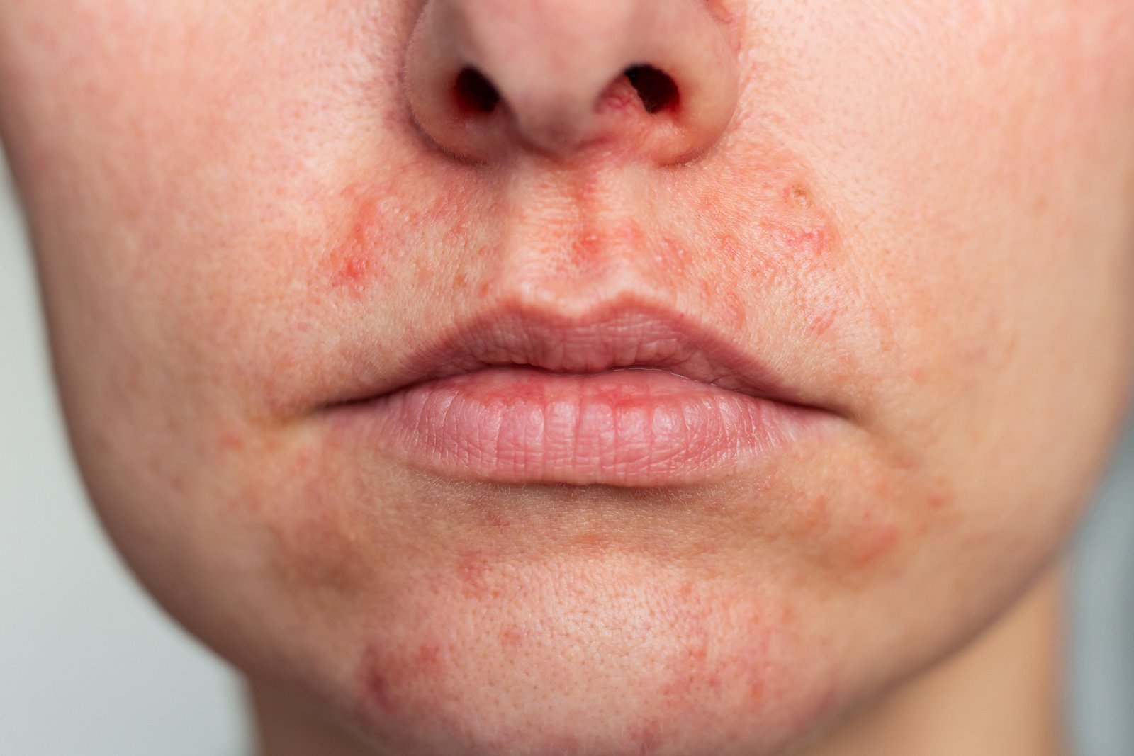Perioral dermatitis — small red papules around the mouth and nasolabial folds, sparing the lip border